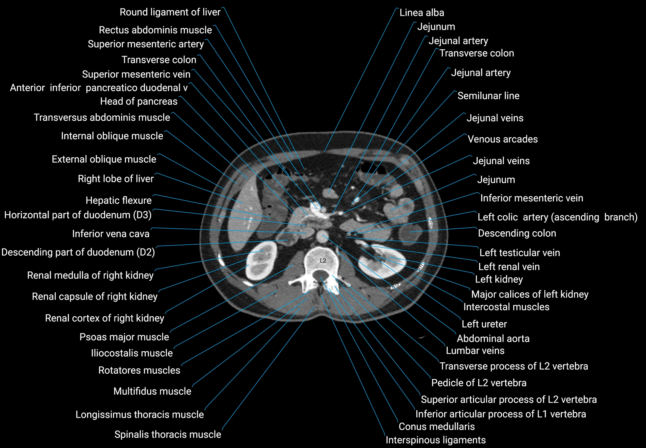 CT male pelvis axial cross sectional anatomy labelled radiology image -00071.webp